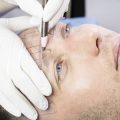 Haartransplantation bei Männern: Moderne Methoden, Möglichkeiten und Risiken