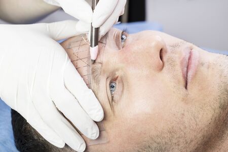 Haartransplantation bei Männern: Moderne Methoden, Möglichkeiten und Risiken